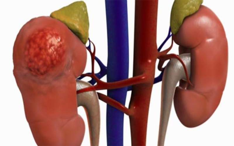 تاثیر قارچ گانودرما بر بیماری کلیوی
