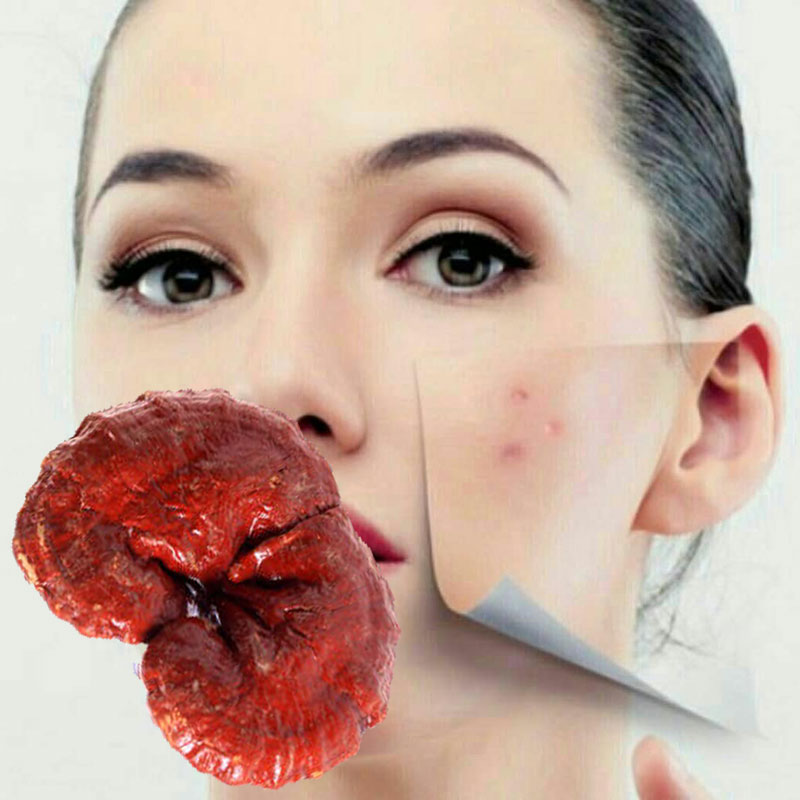 قارچ گانودرما و آکنه