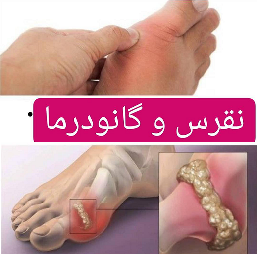 فواید قارچ گانودرما برای درمان بیماری نقرس