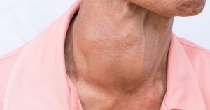 تیرویید هاشیموتو