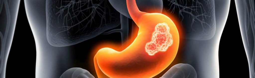 سرطان معده