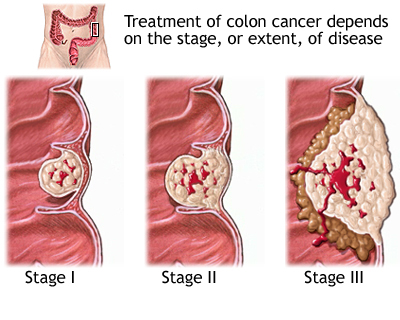 تاثیر مصرف قارچ گانودرما بر سرطان روده بزرگ