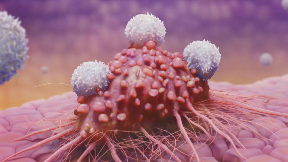پیشگیری و بهبود تومورها با قارچ گانودرما